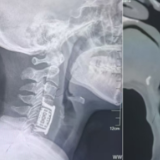 医疗服务提升年丨永州市中心医院成功开展全市首例颈椎3D打印人工椎体置换术