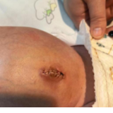 医疗服务提升年丨精准创新，守护新生———永州市中心医院成功为11天新生儿切除“脐肠瘘”