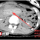 医疗服务提升年丨永州市中心医院：深夜8小时奋战成功挽救车祸重伤少年