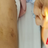 永州市中医医院针灸康复中心特色疗法助患者摆脱夜痛困扰