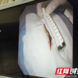 医疗服务提升年丨永州市中心医院成功救治支气管异物合并呼吸衰竭患者