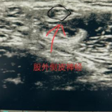 医疗服务提升年丨永州市中心医院：超声引导神经阻滞麻醉助力老年患者快速康复