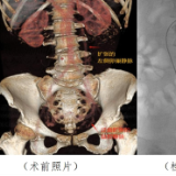 医疗服务提升年丨永州市中心医院：微创介入血管科在盆腔源性静脉疾病诊疗领域取得突破