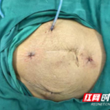 医疗服务提升年丨永州市中心医院微创技术助力八旬老人快速康复