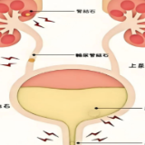 永医科普丨泌尿系结石那些事儿