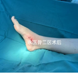 医疗服务提升年丨永州市中心医院：“小切口”拯救扁平足“大问题”