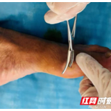 医疗服务提升年丨永州市中心医院用自体PRP凝胶技术治愈高龄糖尿病足患者