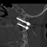 医疗服务提升年丨永州中心医院完成两例高难度寰枢椎骨折手术