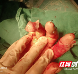 医疗服务提升年丨永州市中心医院：多个手指离断 医者妙手植回