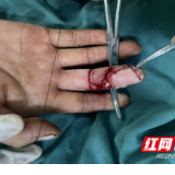 医疗服务提升年丨永州市中心医院成功实施足趾腓侧瓣移植修复手指术