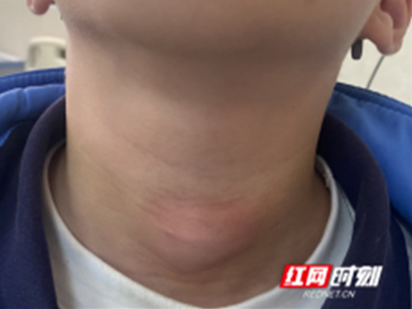 医疗服务提升年丨9岁童颈部反复肿痛三年 永州市中心医院巧除罕见鳃裂瘘管