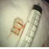 医疗服务提升年丨永州市中心医院成功为七旬老人取出深藏支气管的假牙冠