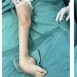 医疗服务提升年丨永州市中心医院成功实施一例后天性马蹄内翻足矫形手术