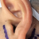 医疗服务提升年丨永州市中心医院耳鼻咽喉头颈外科成功开展腮腺肿瘤美容切除术