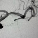 医疗服务提升年丨永州市中医医院脑病科：介入诊疗显硬功 中医康复助安康