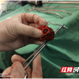 医疗服务提升年丨给肺结节装上“GPS”！永州市中医医院胸外科让微创手术更精准