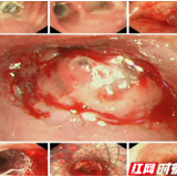 医疗服务提升年丨永州市中心医院成功完成一例复杂气道介入手术成功 打通患者“生命气道”