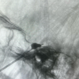 三叉神经痛太折磨？永州市中医医院微创手术终结“天下第一痛”