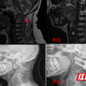 医疗服务提升年丨永州市中心医院成功自主完成全市首例寰枢关节脱位复位固定融合术