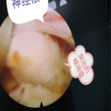 医疗服务提升年丨微创“小孔”除顽疾!永州职院附属医院成功攻克巨大中央型腰椎间盘突出难题