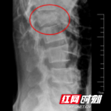 高空坠落腰椎“爆裂” “八钉两棒”保命防瘫