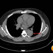 持续咳嗽数日，误以为只是感冒！40岁男子被查出致命主动脉夹层
