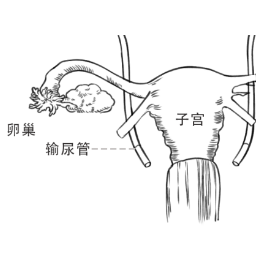 宫颈癌手术就得终生挂尿袋生活？