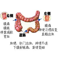 便血就是痔疮?还有可能是这种癌的危险信号!