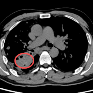湘潭市第一人民医院:肺结核后暗藏的致命动脉瘤,如何精准拆弹?