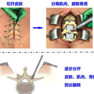 科普｜高龄老人背痛40余年，内镜手术解除多年顽疾