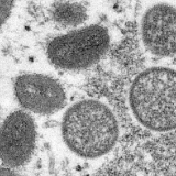 世卫组织：全球已报告近1.4万例猴痘确诊病例，5人死亡