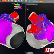 邵阳学院附属第一医院首例心房颤动脉冲电场消融(PFA)手术圆满完成