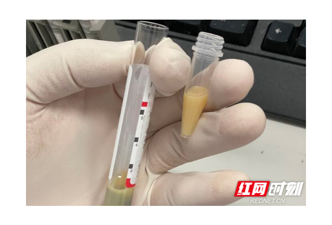 术后急着补身体,六旬老人抽出“牛奶血”