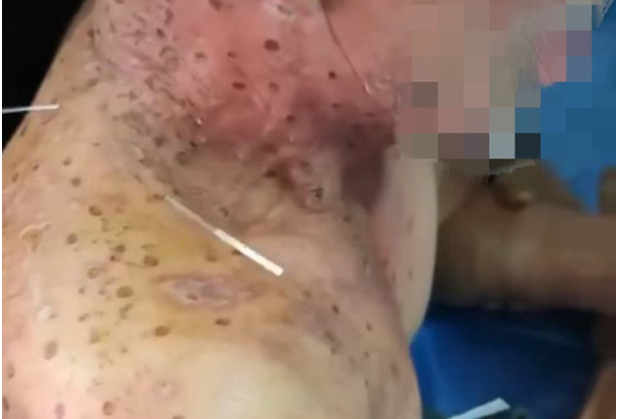 一旦感染疱疹病毒，终身携带！这种痛只有经历过才懂……