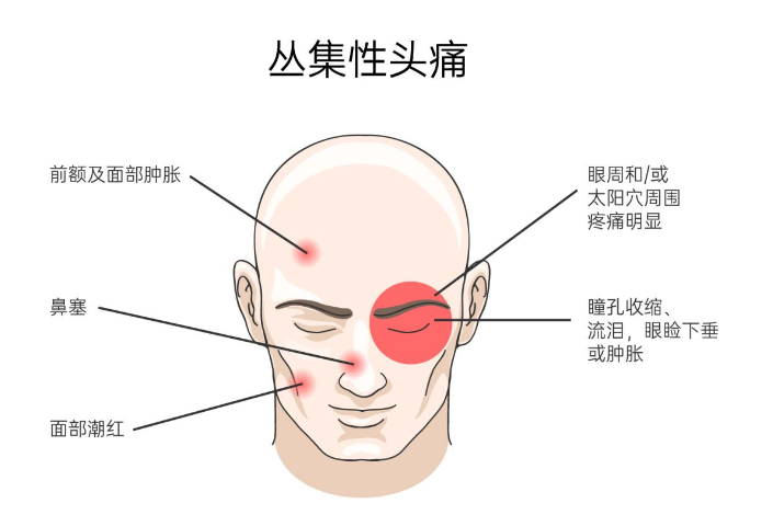 关于丛集性疼痛 你不知道的事