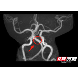 脑血管长歪了也可导致中风？看脑科专家如何支招