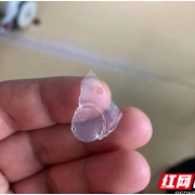 猛喝奶茶误吞破碎杯盖 医生巧手取异物化险为夷