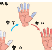 你以为的“冻疮”，可能是“红斑狼疮”