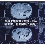 37岁小伙肝脏长满肿瘤 肿瘤专家手把手教如何体检