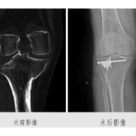 娄底市二医院微创新技术治疗胫骨平台骨折