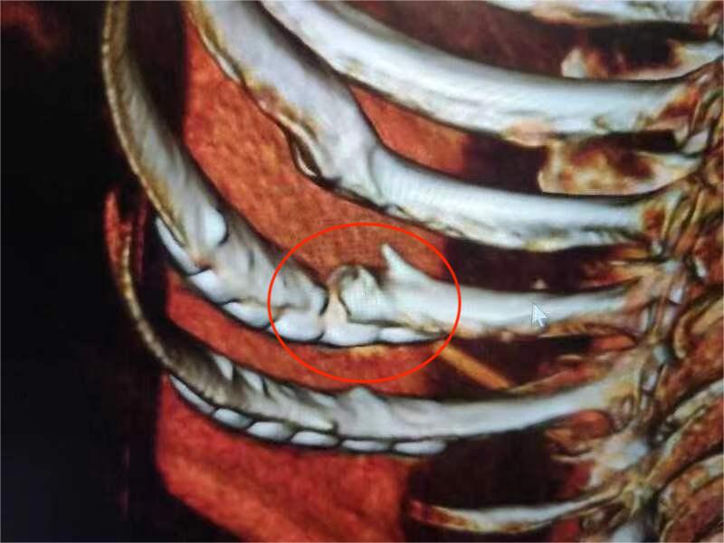 术前胸部CT三维成像提示：右侧第10肋骨骨折断端愈合不良（红圈处）。.jpg