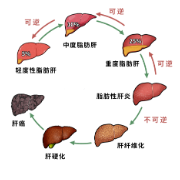 全国爱肝日 | 别低估肝脏“胖了”的危害