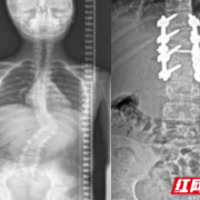 脊柱“皇冠手术” 助12岁脊柱侧弯少年重获新生
