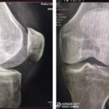 尿毒症患者膝关节剧烈疼痛 原来是患上了晶体性关节炎