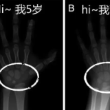 “测骨龄”是智商税？面对“身高焦虑” 超声测量有新招