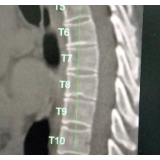 CT+AI，骨密度检测一步到位！