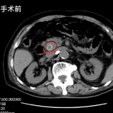 2小时微创术 取出91岁高龄老人胆总管内大量结石