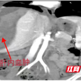 小孩玩滑板摔倒肝脏破裂出血 湖南省儿童医院精准手术成功救治