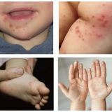 手足口病进入高发季 专家提醒：科学防控