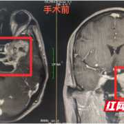 6厘米神经鞘瘤“埋伏”脑干 专家团队10小时精准“排雷”